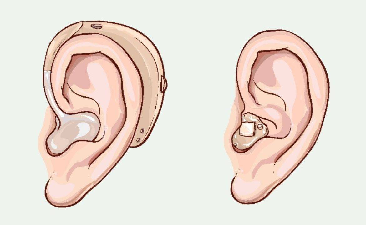 Hallókészülékek fajtái